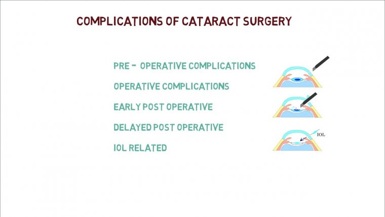 What Are the Main Cataract Surgery Complications