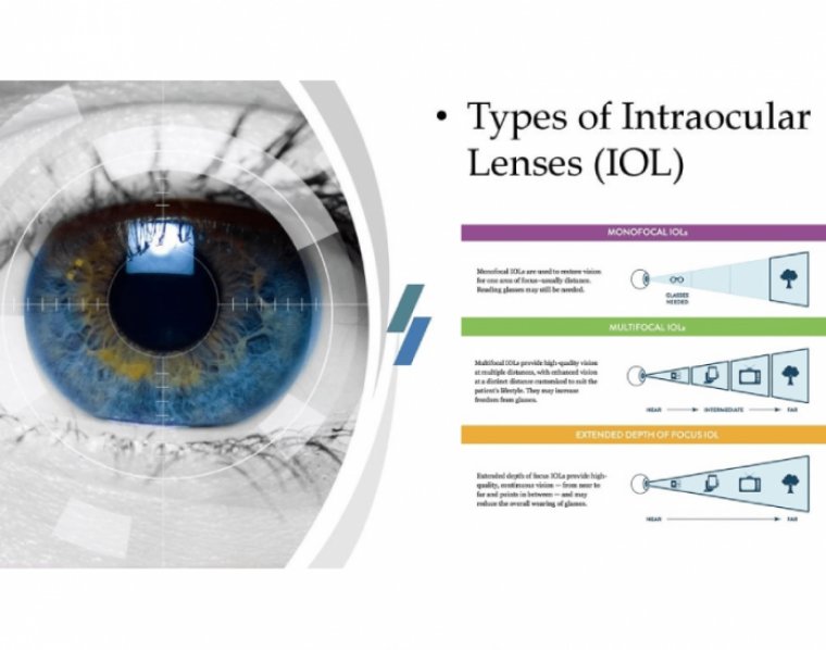 What Is The Best Lens For Your Cataract Surgery?