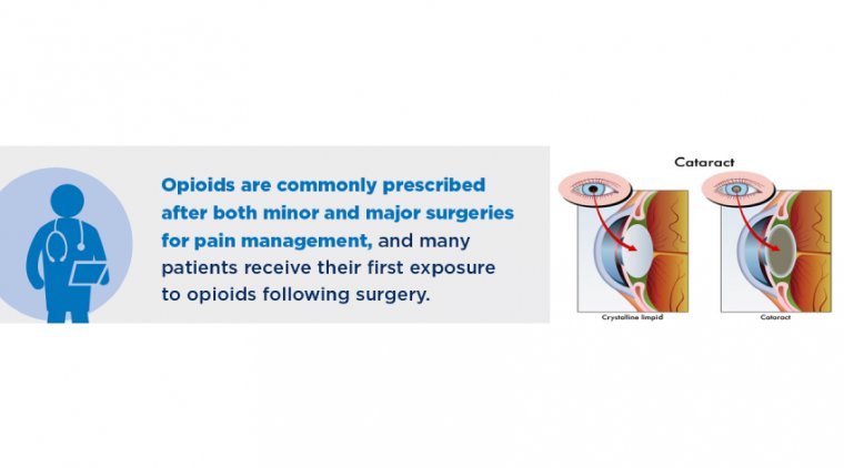 What is the Role of Opioids in Cataract Surgery